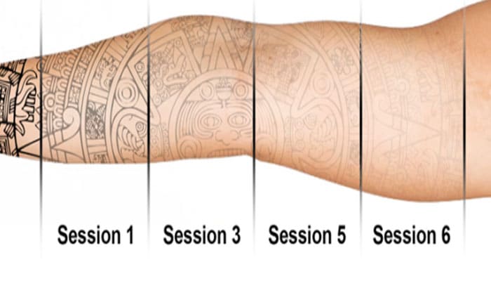 sesiones para borrar tatuajes