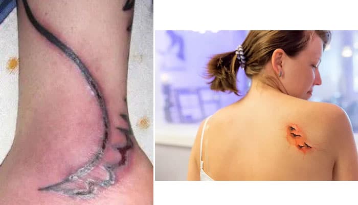 cómo saber cuándo un tatuaje está infectado