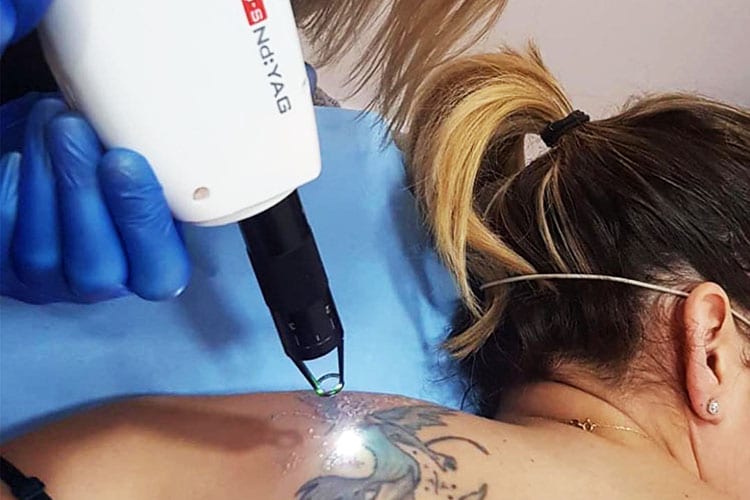 elimar tatuajes lasere
